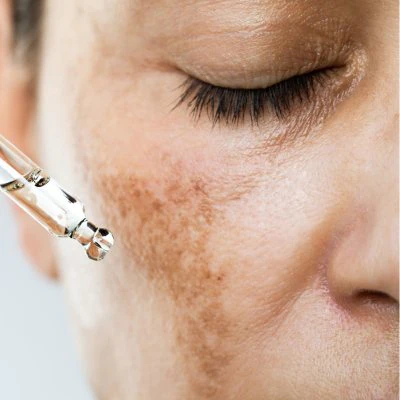 Hyperpigmentation Treatments