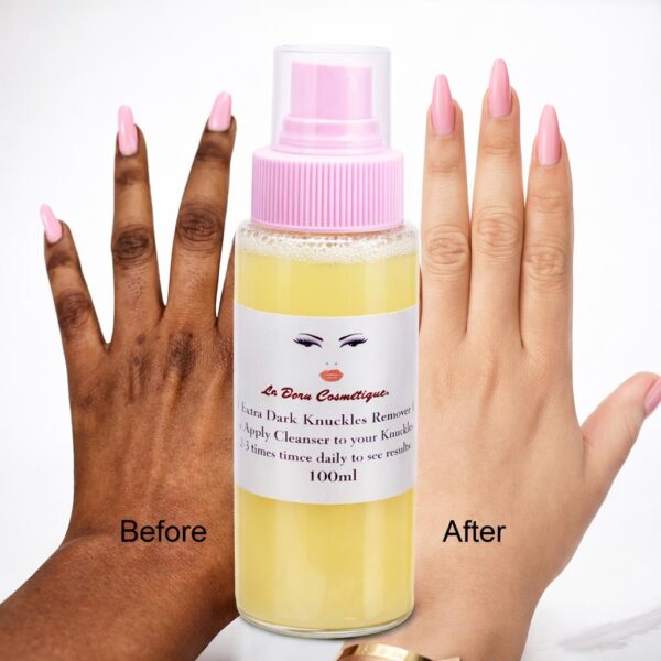 Dark Knockles Treatment